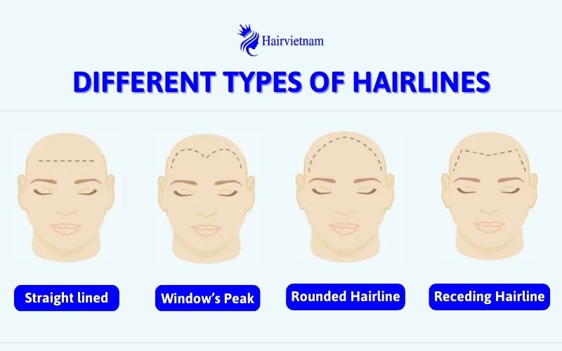 Receding Hairlines Causes And Tips For Prevention